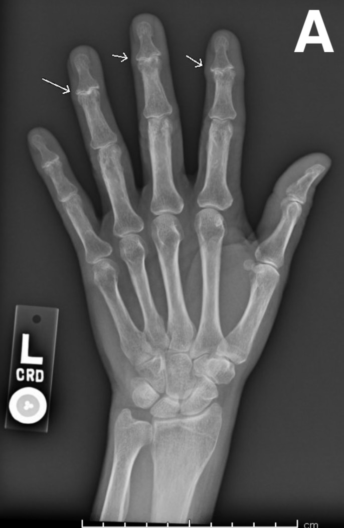 A Woman With Worsening Hand Pain and Stiffness Consultant360